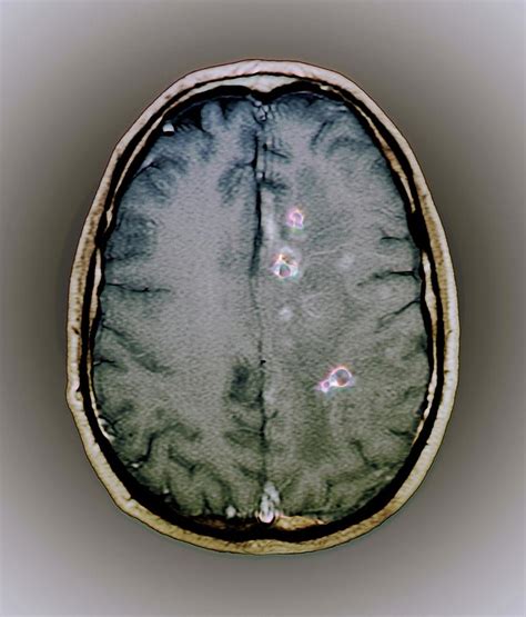 Tapeworm Cysts In The Brain Photograph by Zephyr/science Photo Library