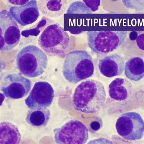 Multiple Myeloma Alternative Treatment - Captions Cute Viral