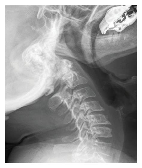 AP (a) and lateral (b) X-rays depicting a C1/2 fusion using C2 ...