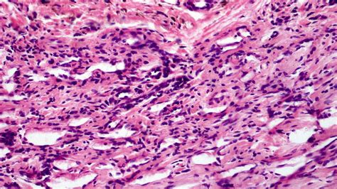 How well do you know Angiomatosis