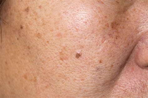 What Is Melasma? - Treatment - Causes | familydoctor.org