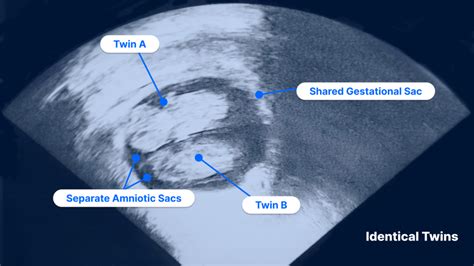 Twin Pregnancy Ultrasound | PocketHealth