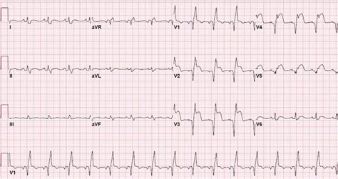 Anterior Wall ST elevation MI with RBBB ECG (Example 2) | Learn the Heart