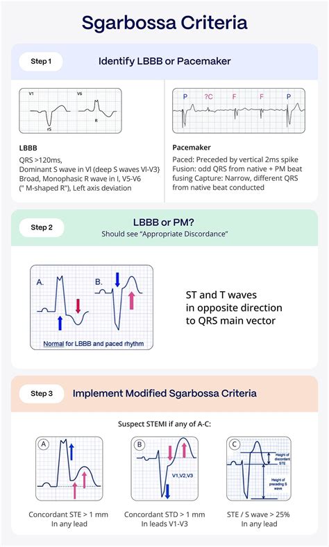 Sgarbossa Criteria: Advanced Cardiac Diagnosis | PMcardio