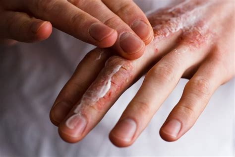 Epidermolytic Ichthyosis Symptoms and Treatment: Hines Dermatology ...