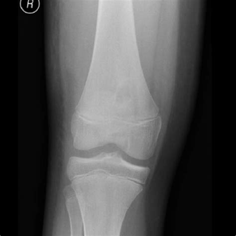 Coronal slice images of presenting MRI, displaying the brodie's abscess ...