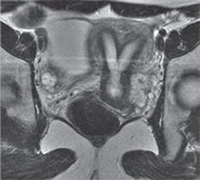 136 Bicornuate Uterus | Radiology Key