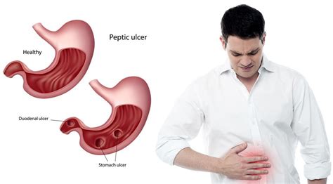 Peptic Ulcer Symptoms