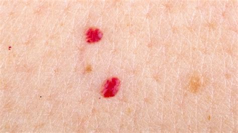 Cherry Angiomas: Diagnosis & Treatment - Toronto Dermatology Centre