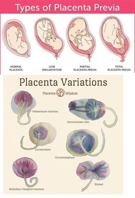 Placenta variations and what they look like | Nursing school notes ...