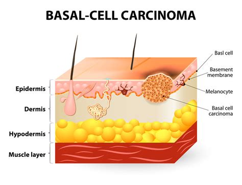 Basal cell carcinoma,rodent ulcers