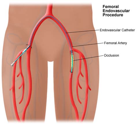 Albums 94+ Pictures Ptca Is An Acronym For Percutaneous Transluminal Coronary Angioplasty Excellent