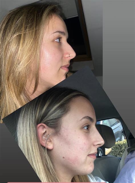 Before & after non surgical nose job : r/PlasticSurgery