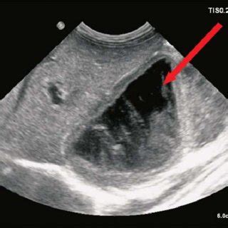 Ultrasound showing right adrenal hematoma (seventh day of life). | Download Scientific Diagram