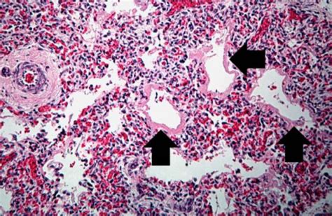 IPLab:Lab 13:Hyaline Membrane Disease - Pathology Education Instructional Resource