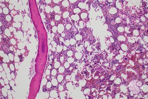 Panel A, 10X: Focal area of epithelioid cells in bone marrow core biopsy