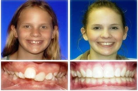 Headgear Braces Before and After - Headgear Braces