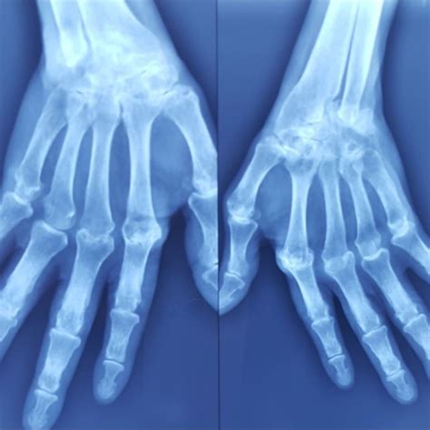 Rheumatoid arthritis with ulnar deviation of the metacarpal-phalangeal... | Download Scientific ...