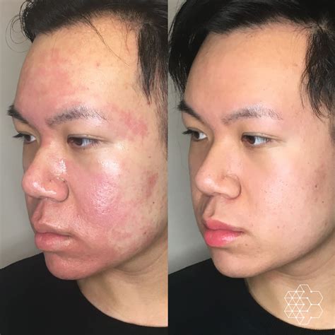 Acne Scar Treatment & Removal Vancouver BC | Skin Technique