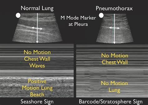 Intern Ultrasound of the Month: Pneumothorax — University Hospitals Emergency Medicine Residency