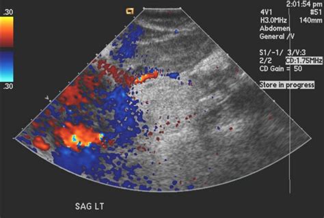 Angiomyolipoma ultrasound - wikidoc