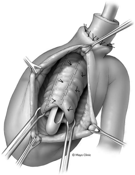 Schematic detailing the anatomy and surgical technique in creating a... | Download Scientific ...