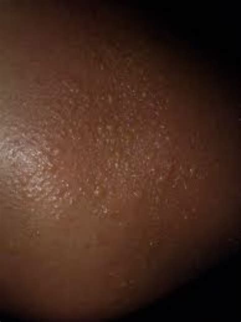 10 Most Common Skin Rashes On Black Skin | Hives On Black Skin