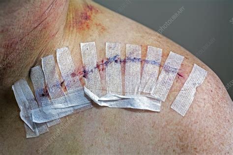 Collar bone surgery - Stock Image - C020/3855 - Science Photo Library