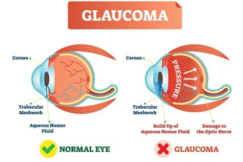 Glaucoma Symptoms Eye