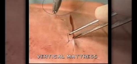 How to Perform a vertical mattress suture during surgery « First Aid :: WonderHowTo