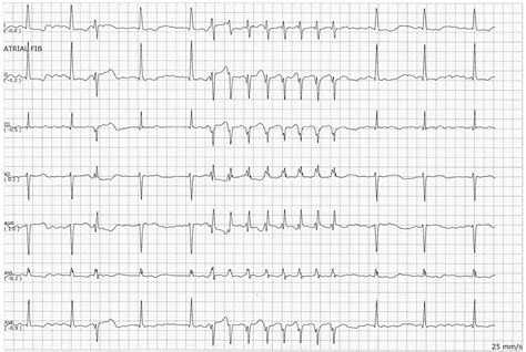 Float Nurse: EKG rhythm Strips