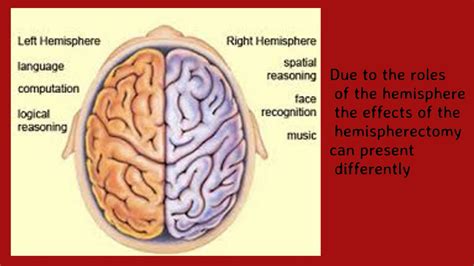 Rasmussen Encephalitis - YouTube