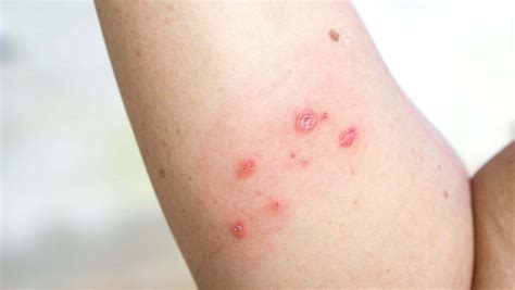 Boils And Skin Infections Treatment During The Rainy Season - Sparsh Skin Clinic