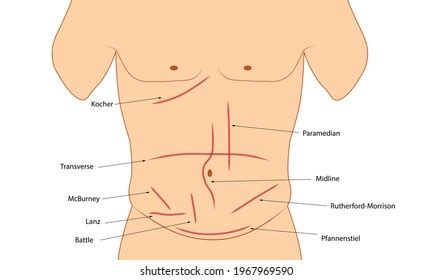 Abdominal Incision Different Types Abdominal Incision Stock Illustration 1967969590 | Shutterstock