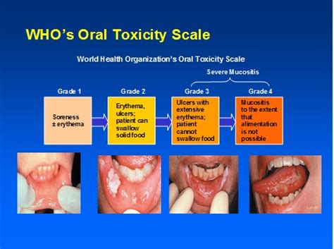 Stomatitis From Chemotherapy