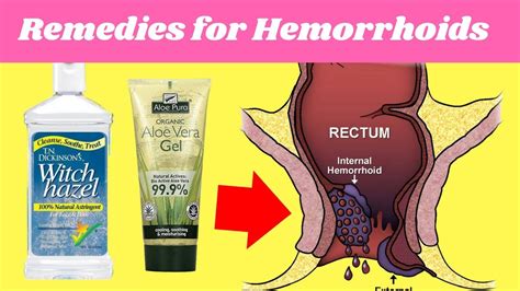 4 Home Remedies for Hemorrhoids | Hemorrhoid No More - YouTube