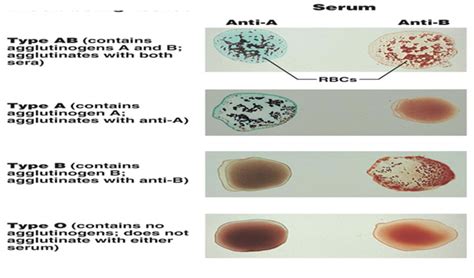 Agglutination reaction (ABO blood grouping) - Biyani Group of colleges