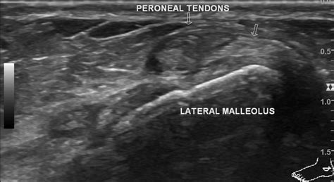 Peroneal Tendonitis Ultrasound