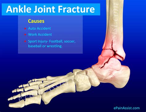 Ankle Joint Fracture|Types|Classification|Symptoms|Treatment|Recovery