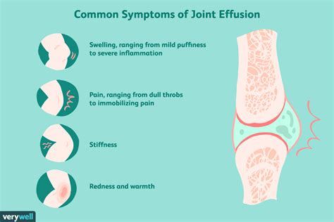 Joint Effusion: Symptoms, Causes, Diagnosis, Treatment