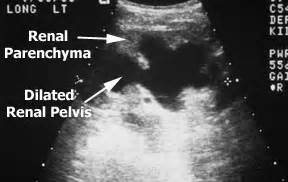 Kidney Ultrasound: Hydronephrosis