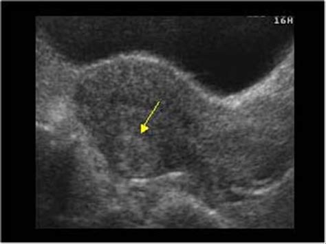 Gynaecology | 3.1 Uterus : Case 3.1.1 Uterine fibroids | Ultrasound Cases