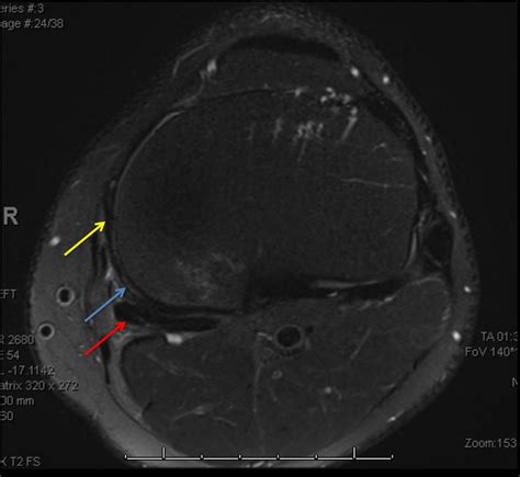 Posteromedial Corner Injury - Knee & Sports - Orthobullets