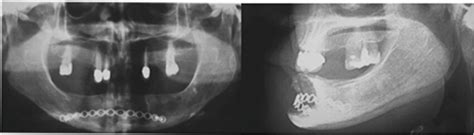 Orthopantomography 3 months after surgical procedure and it was... | Download Scientific Diagram