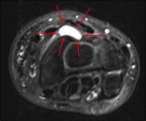 Ganglion Cyst - Raleigh Hand Surgery — Joseph J. Schreiber, MD