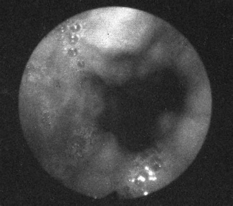 Upper endoscopy showing preoperative proximal upper esophageal varices. | Download Scientific ...