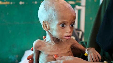 Somali Children Dying of Starvation - UNICEF