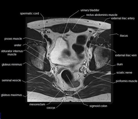 28 best MRI MALE PELVIS images on Pinterest | Pelvis anatomy, Cross stitches and Crosses