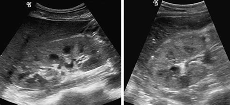 Diffuse Renal Parenchymal Diseases | Radiology Key