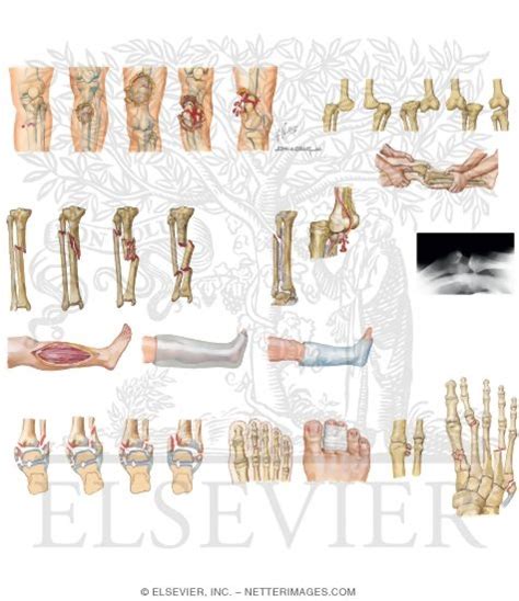 Lower Extremity Fractures and Dislocations